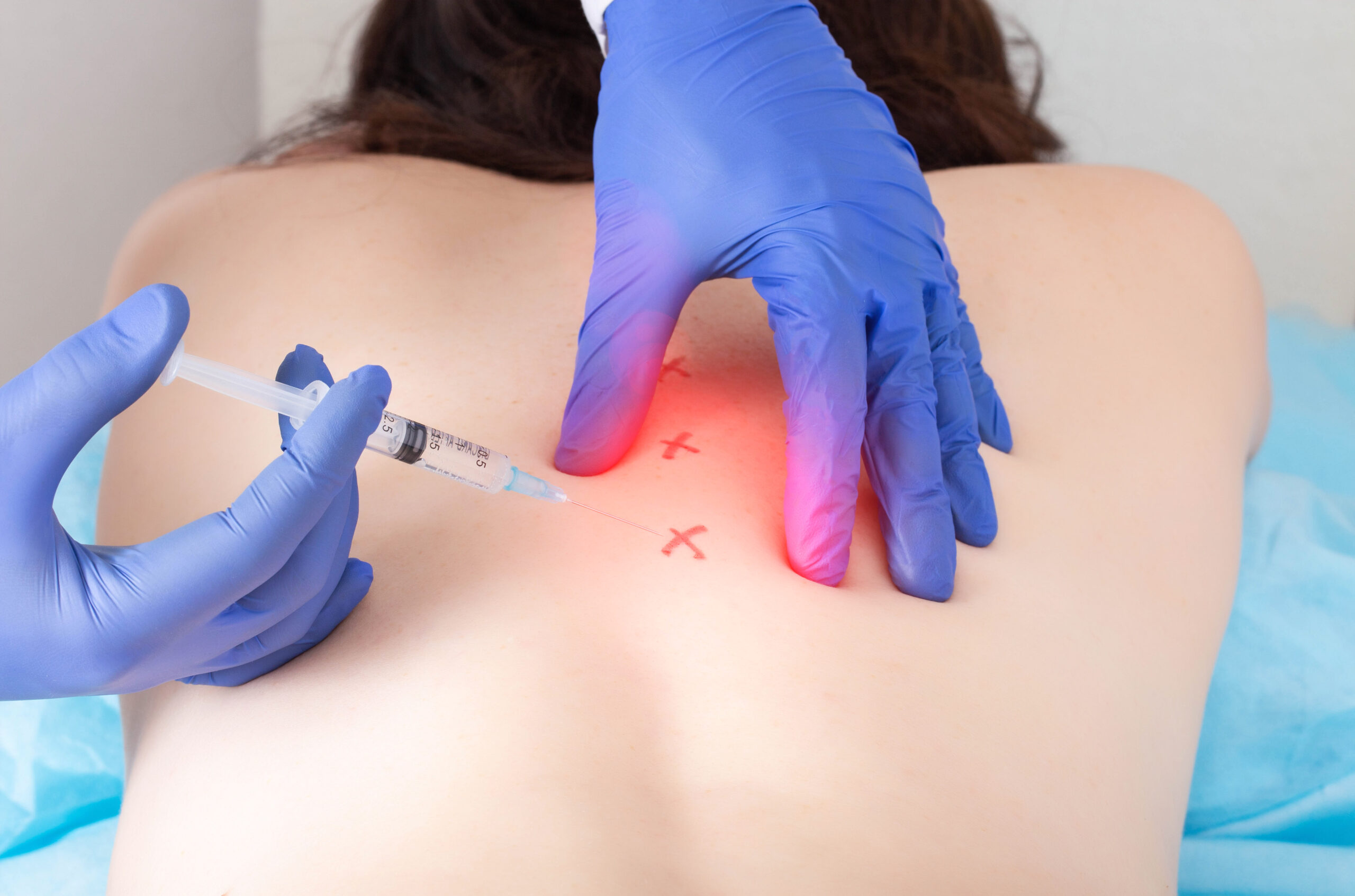 Cerebrospinal injection with ozone to relieve pain and inflammation in the back. Treatment of osteochondrosis and arthrosis of the spine with blockade therapy
