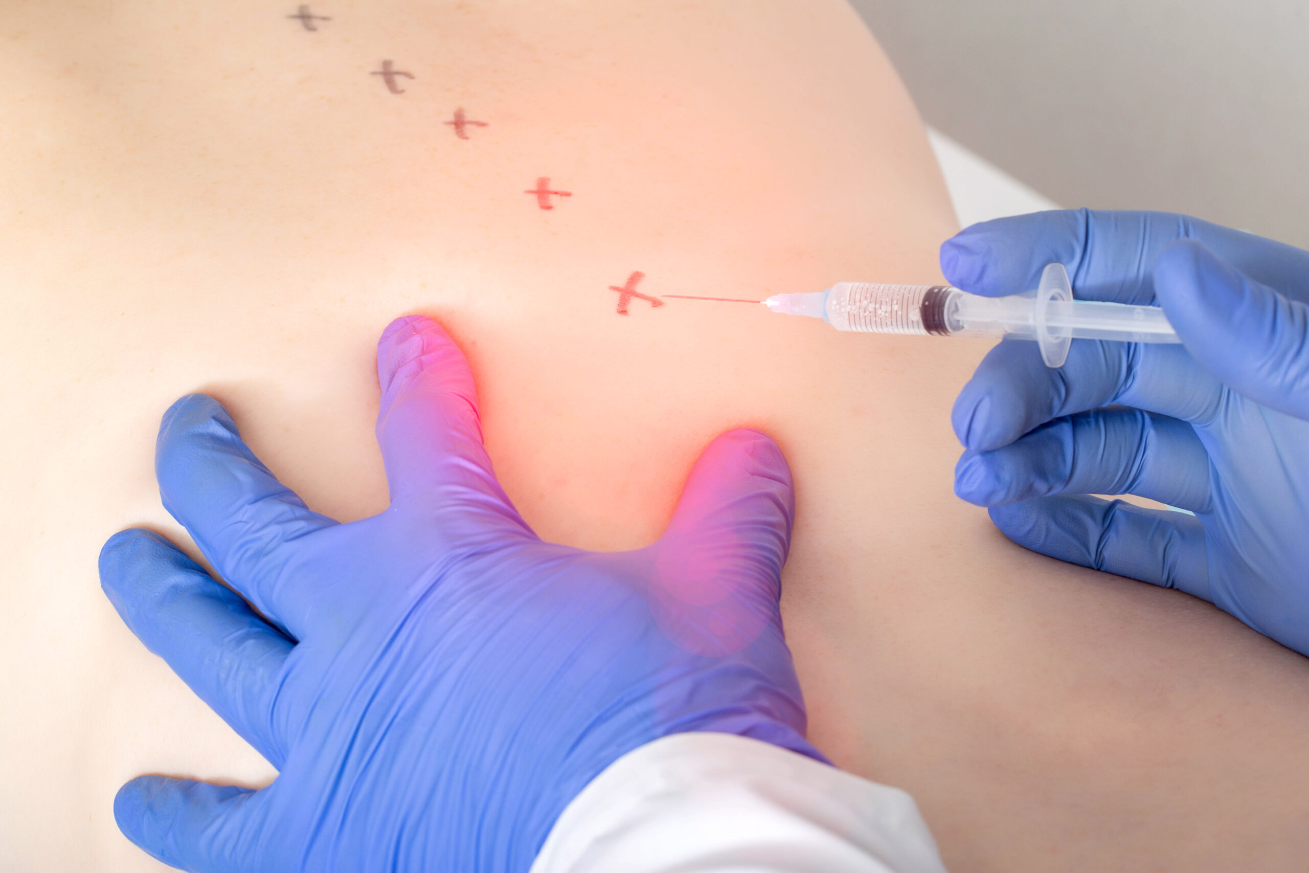 medical spinal block for the treatment of intervertebral disc herniation and protrusion. Concept of a modern treatment for pain relief, blockade therapy